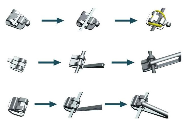 Lingual bracket